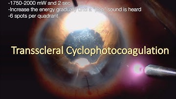 Silicone Oil Removal and Transscleral Cyclophotocoagulation in Patient with Secondary Glaucoma