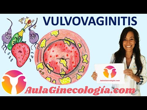 VULVOVAGINITIS: Síntomas, causas, diagnóstico y tratamiento   - Ginecología y Obstetricia -