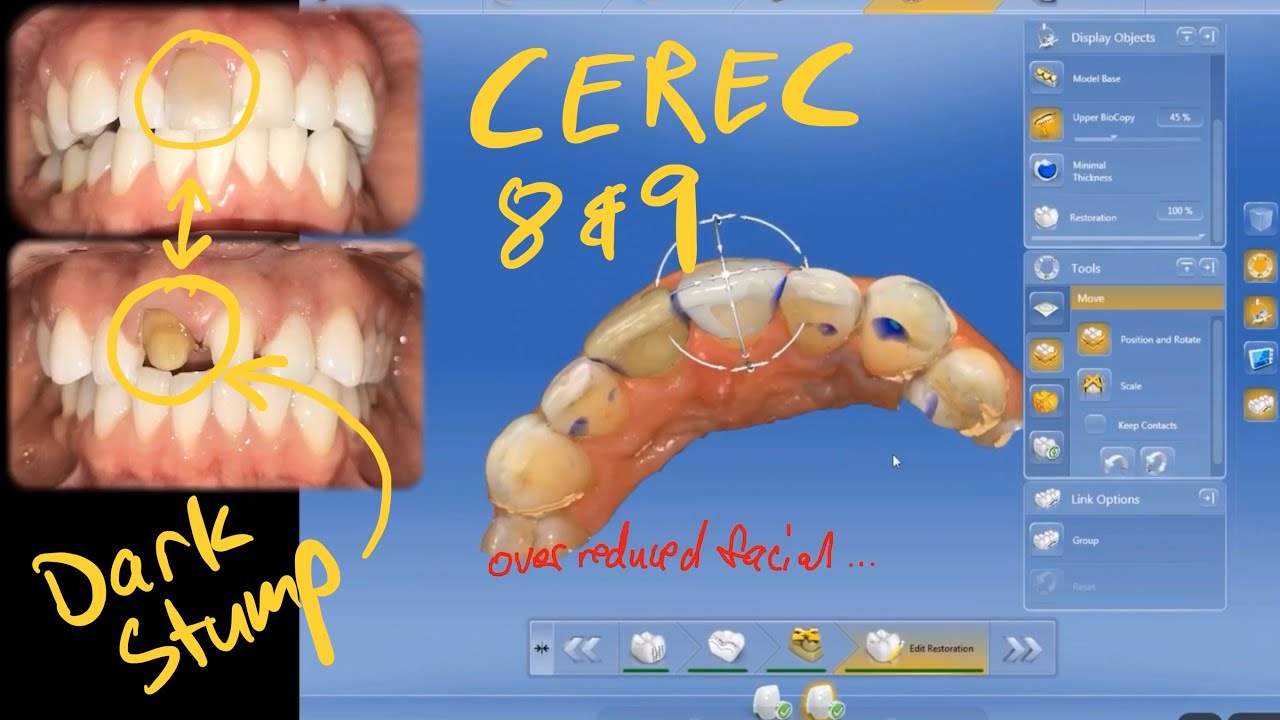 CEREC crowns 8/9 same day crowns. E.max. Dark stump.