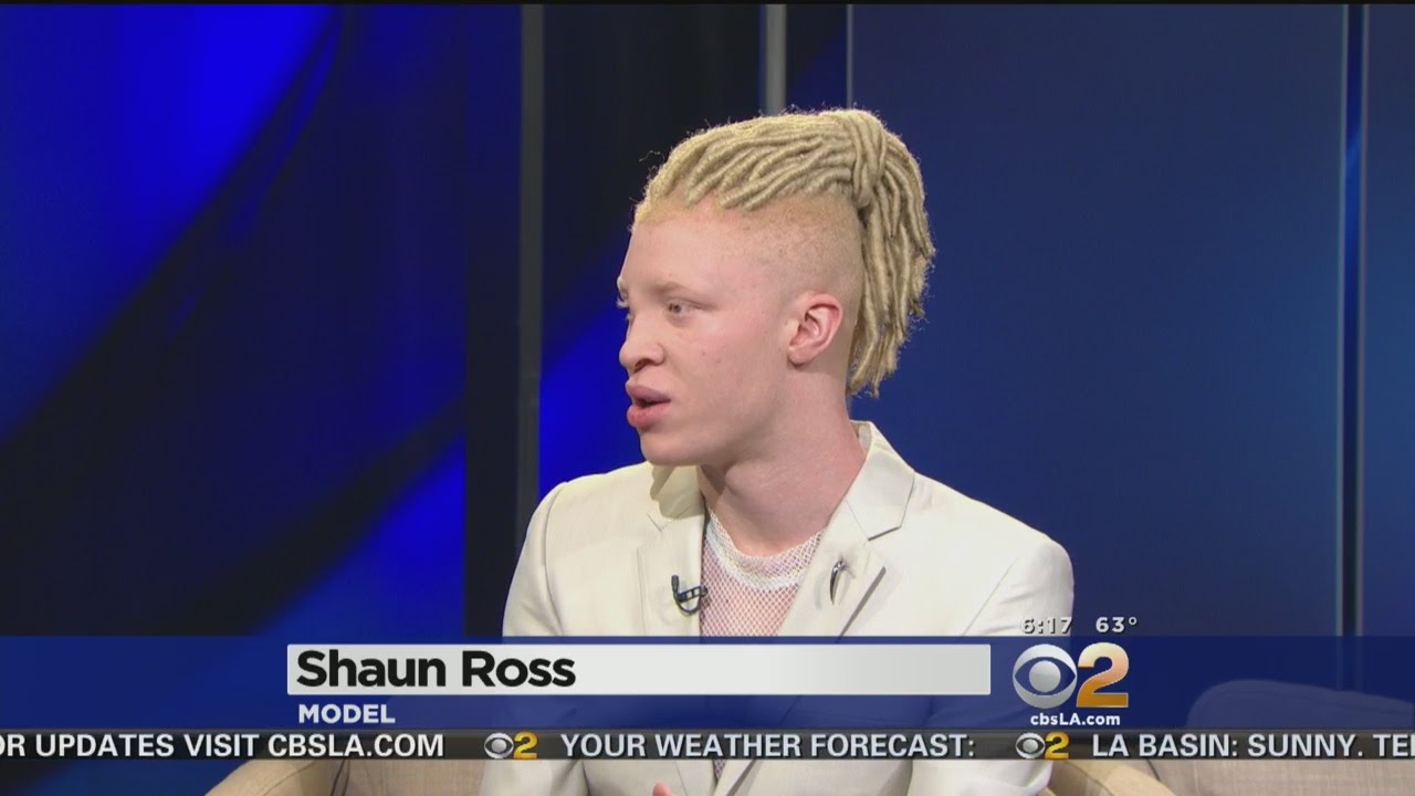 First Male Model With Albinism Says He Loves The Skin He S In Youtube