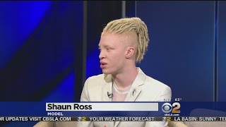 First Male Model With Albinism Says He Loves The Skin He's In First Male Model With Albinism Says He Loves The Skin He's In