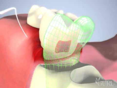 Vidéo: Qu'est-ce que l'odontoplastie dentaire ?
