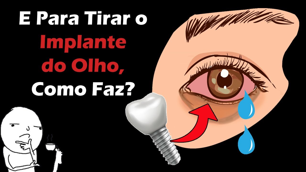 O Curioso Caso do Implante Dental que Foi Parar NO OLHO do Paciente ...