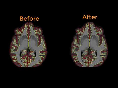 FreeSurfer #14: Intensity Normalization and Control Points