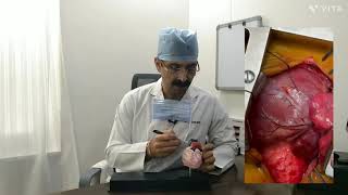Truncus Arteriosus Surgery By Dr. Rajan Modi