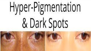Remove Hiper Pigmentation and Dark spots in natural way
