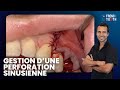 Gestion dune perforation sinusienne  dr popelut