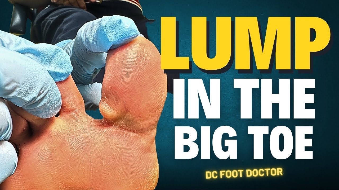 I Have A Lump Under My Big Toe