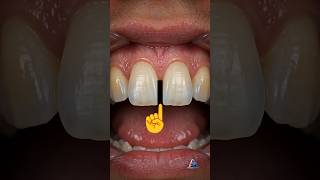 Satisfying Tooth Gap Restoration 🦷 |  How Dentists Fix Tooth Gaps Without Braces