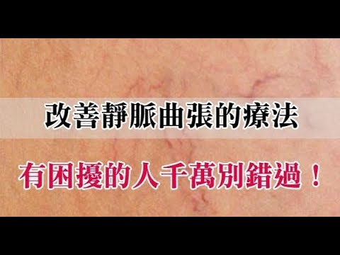 便宜又簡單，改善靜脈曲張的奇蹟小療法，有困擾的人千萬別錯過！
