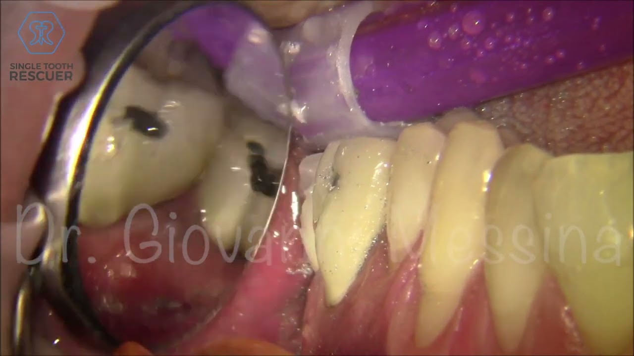 Kit Professionale Per Rimuovere Corone E Ponti Dentali - Strumento Di Precisione Per Laboratorio Odontotecnico E Cliniche