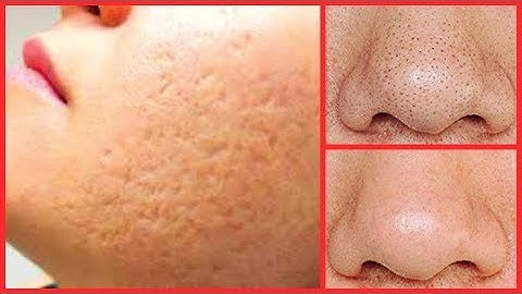 2 SIMPLE STEPS TO SHRINK LARGE PORES, CLEAR BLACKHEADS, WHITEHEADS, GET RID OF ROUGH LOOKING SKIN