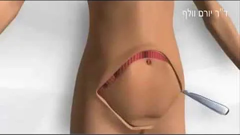 Como é feito cirurgia plástica no rosto?