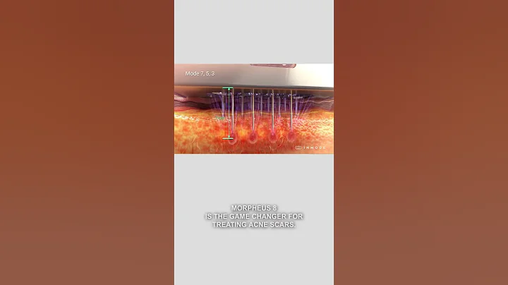 Smooth skin hack: Morpheus 8 for acne scars!