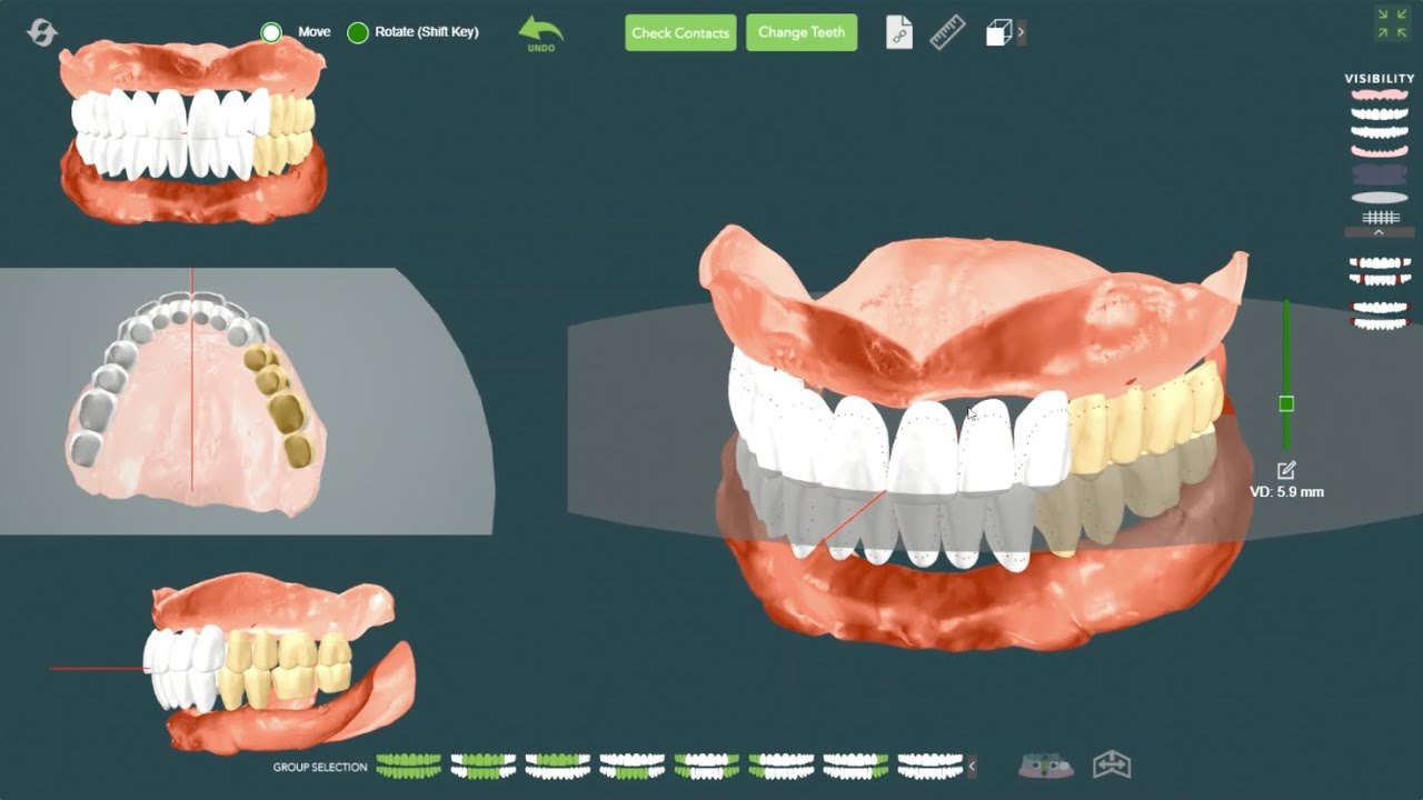 2分でわかる！Digital Denture】3Dプリント技術で作る義歯rēva（設計