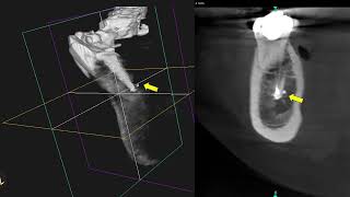 CBCT in diagnosis of periapical lesions. Prof Hussain Al-Huwaizi