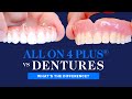 All on 4 plus vs dentures  what are the differences