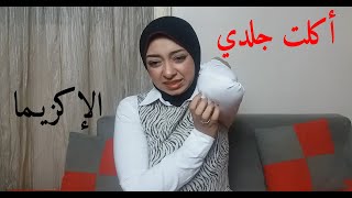 تجربتي مع الإكزيما والحساسية الجلدية | علاج الإكزيما نهائيا