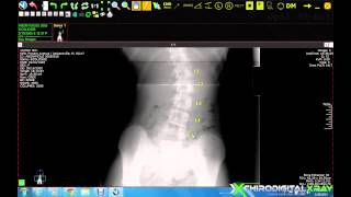 Chiropractic Digital X-ray Software | Spine Labeling