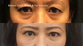 #ChaseLayMD Asian Blepharoplasty & Fat Transfer