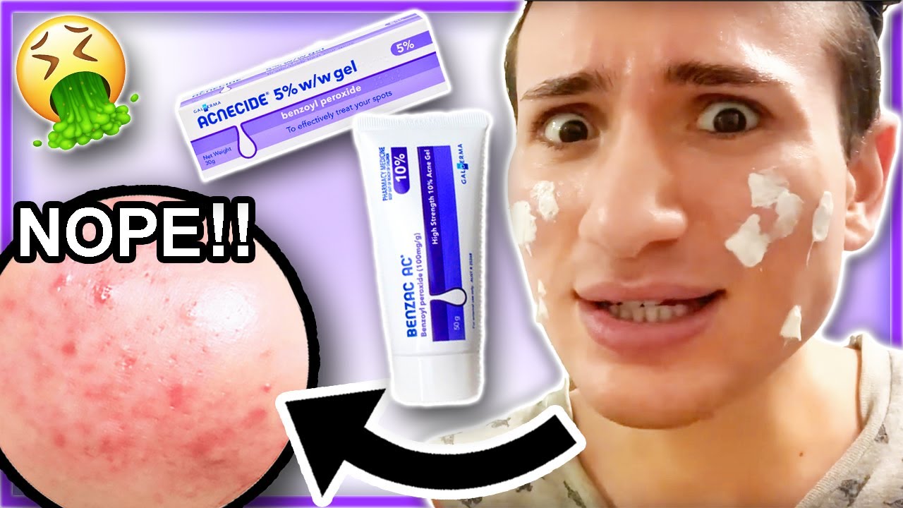 I Tried Benzoyl Peroxide Acnecide For One Week!! (It Caused A Rash?!)