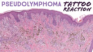 Tattoo Reaction/Rash - pseudo-lymphoma mimic of mycosis fungoides (Stony Brook case 2) dermpath