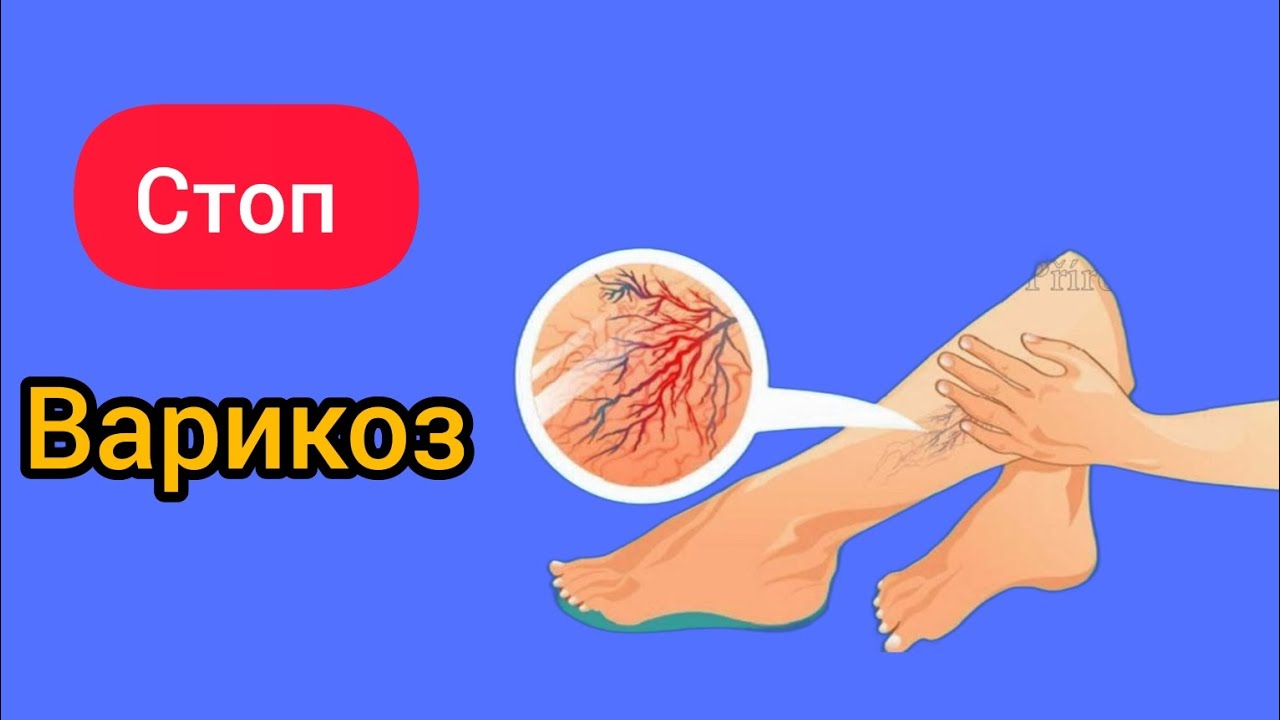 Все о варикозе.Виды, профилактика, эффективные методы лечения! - YouTube
