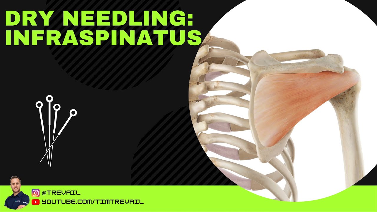 Dry Needling Infraspinatus YouTube