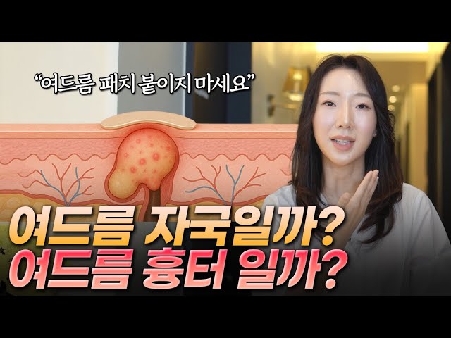 "평생 얼굴에 남아요." 여드름 흉터 vs 자국 3초 판별법!