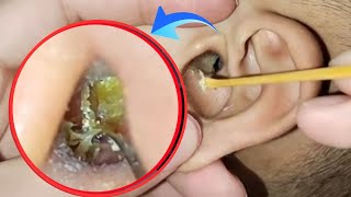 Deep Ear Cleaning Gone Viral 😱 | Shocking Wax Removal ASMR | EP 124
