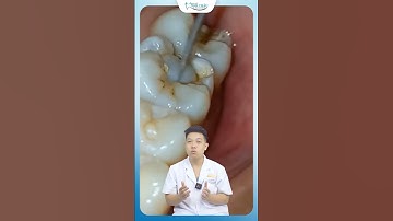 Cận Cảnh Mối Hàn Composite Trên Mặt Nhai | Nha Khoa Minh Châu