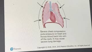 Chest Trauma