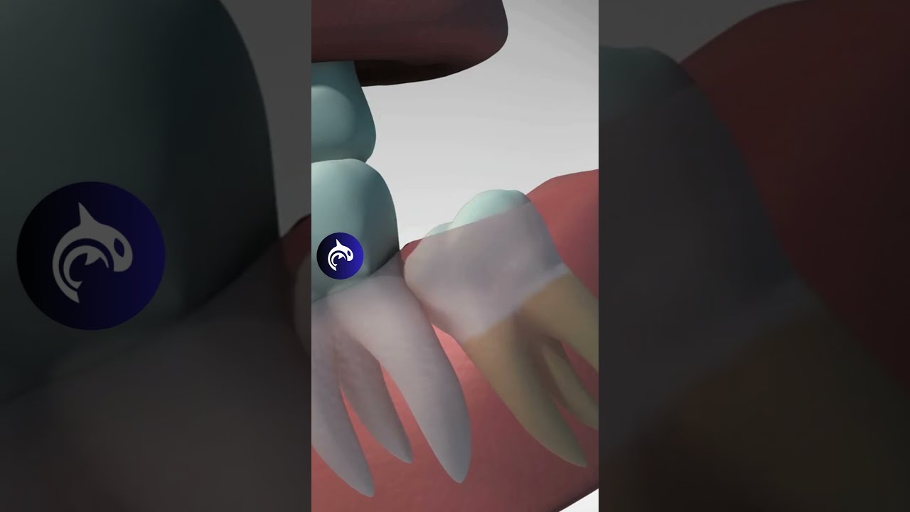 Wisdom Teeth Removal 4k 3d Animation