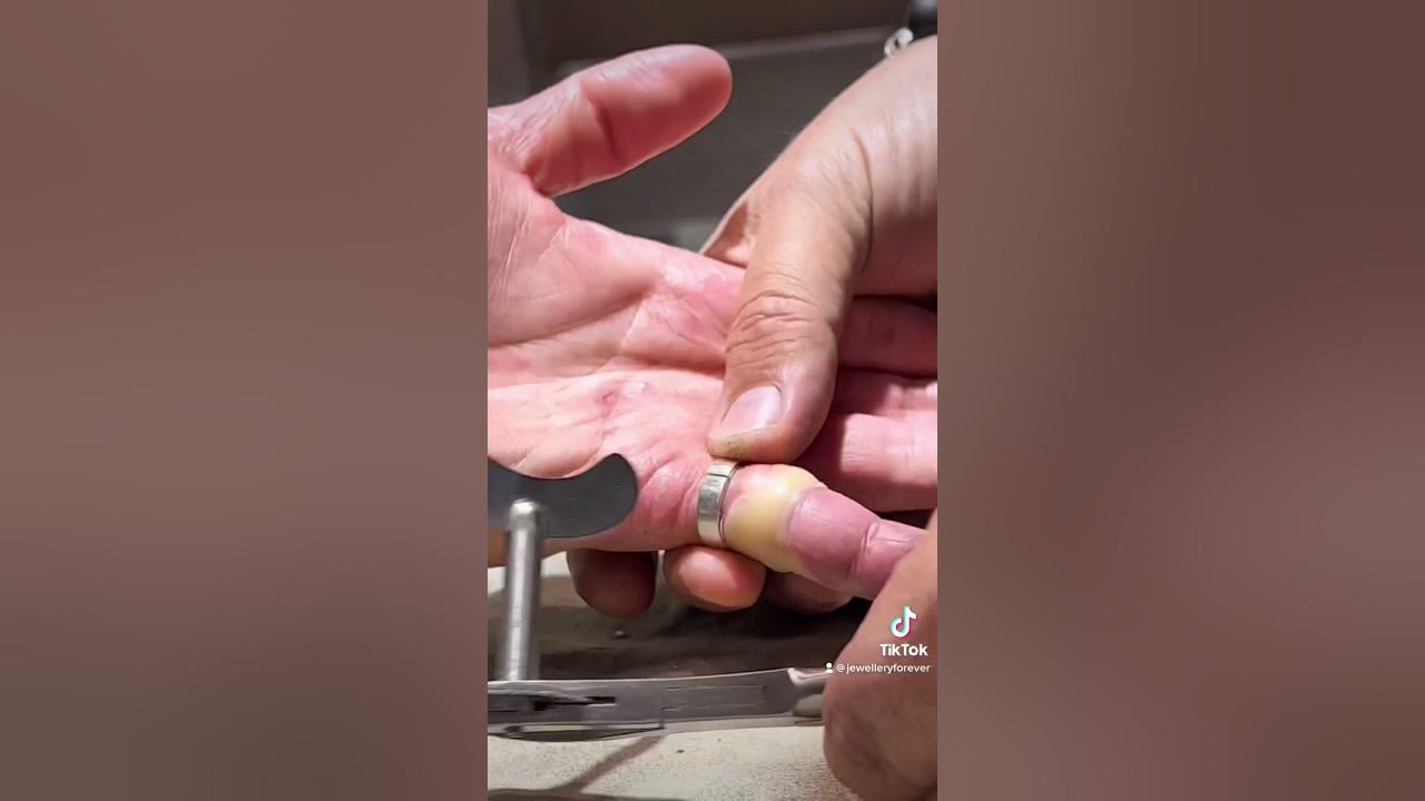 ANGRY FINGER Stuck Ring Removal Using The Ring Rescue Compression