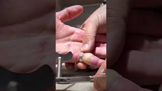 Cutting off a ring from a finger. Jewellery repair, jewelry, fix