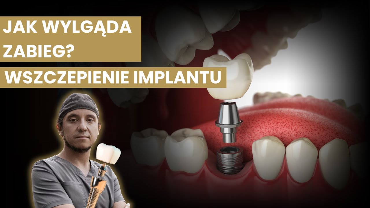 Leczenie IMPLANTOLOGICZNE – JAK wygląda zabieg KROK PO KROKU?