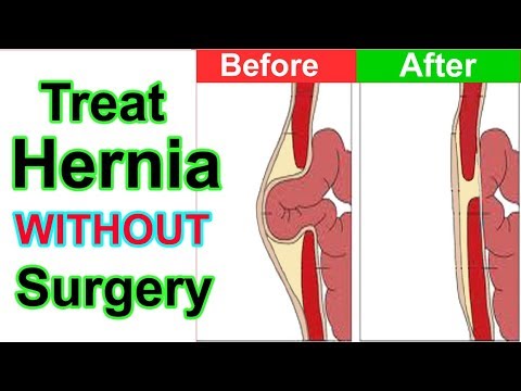 How To Cure Hernia Without Surgery Hernia Treatment - 