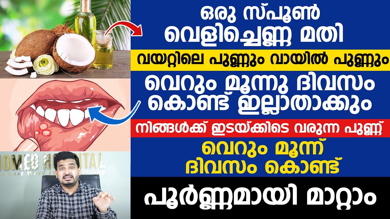 ഒരു സ്പൂൺ വെളിച്ചെണ്ണ മതി വയറ്റിലെ പുണ്ണും വായിൽ പുണ്ണും വെറും മൂന്നു ദിവസം കൊണ്ട് ഇല്ലാതാക്കും