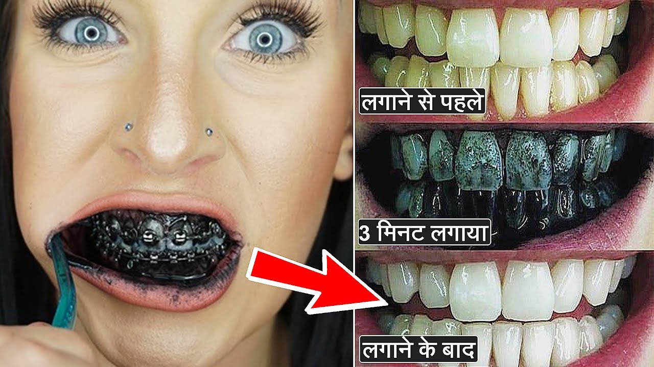 मात्र 3 मिनट मे गंदे पीले दांतों को मोतियों की तरह चमका देगा ये नुस्खा