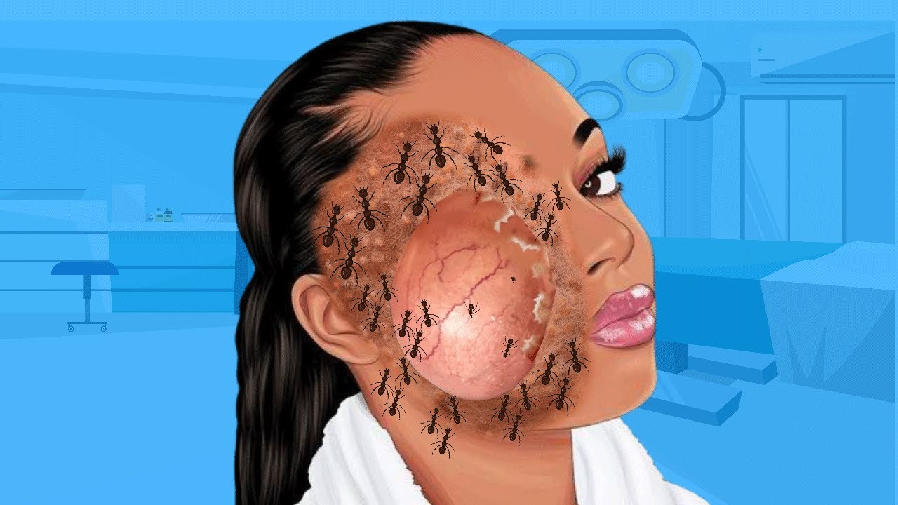 ASMR ​​​ Remove big acne,parasites, Insects, tickc from infected Face -  Remove parasites 01
