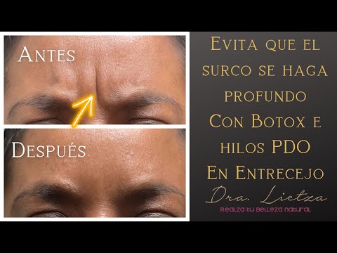 ¡Adiós a las arrugas del entrecejo! | Evita que se hagan SURCOS |con Botox 💉 e Hilos PDO 🧵