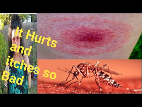 Mosquitos Bites? Lamok Go Away If You Have This Plant! #cintronellaplant #naturelovers #mosquitos Mosquitos Bites? Lamok Go Away If You Have This Plant! #cintronellaplant #naturelovers #mosquitos