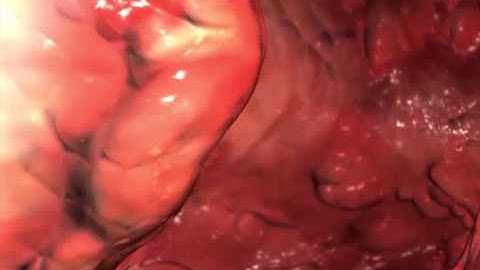 Ulcerative Colitis: Learn@Visible Body