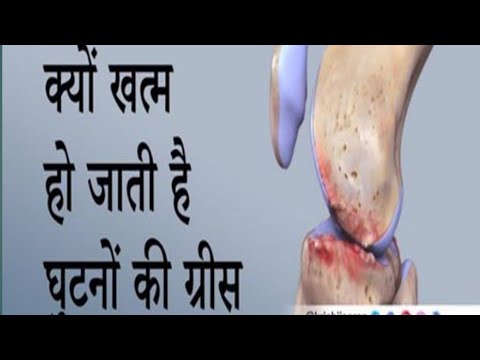 #nursingvilla#healthtips#shortvideo घुटनों का दर्द कैसे कम करें घुटनों की ग्रीस खतम होने पर क्या करे