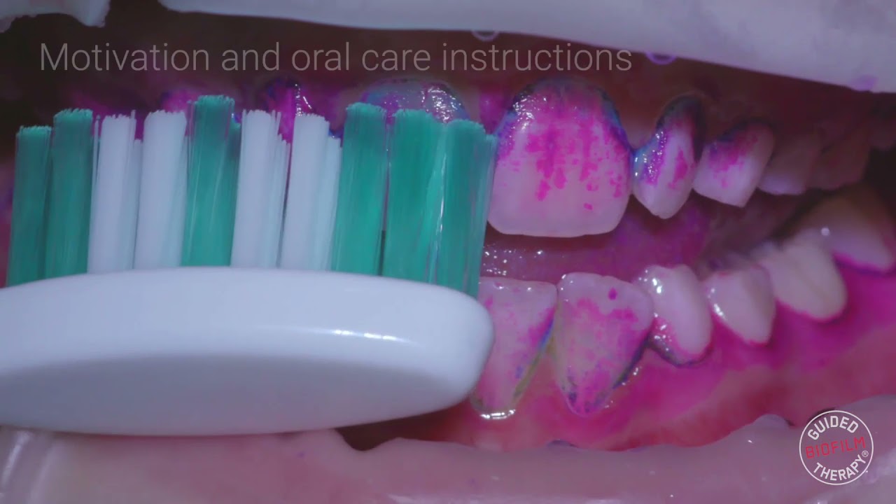 Gold standard teeth cleaning using Airflow.... Experience the difference! YouTube