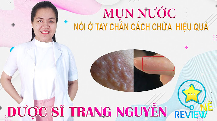 Nguyên nhân lên mụn nước ở tay