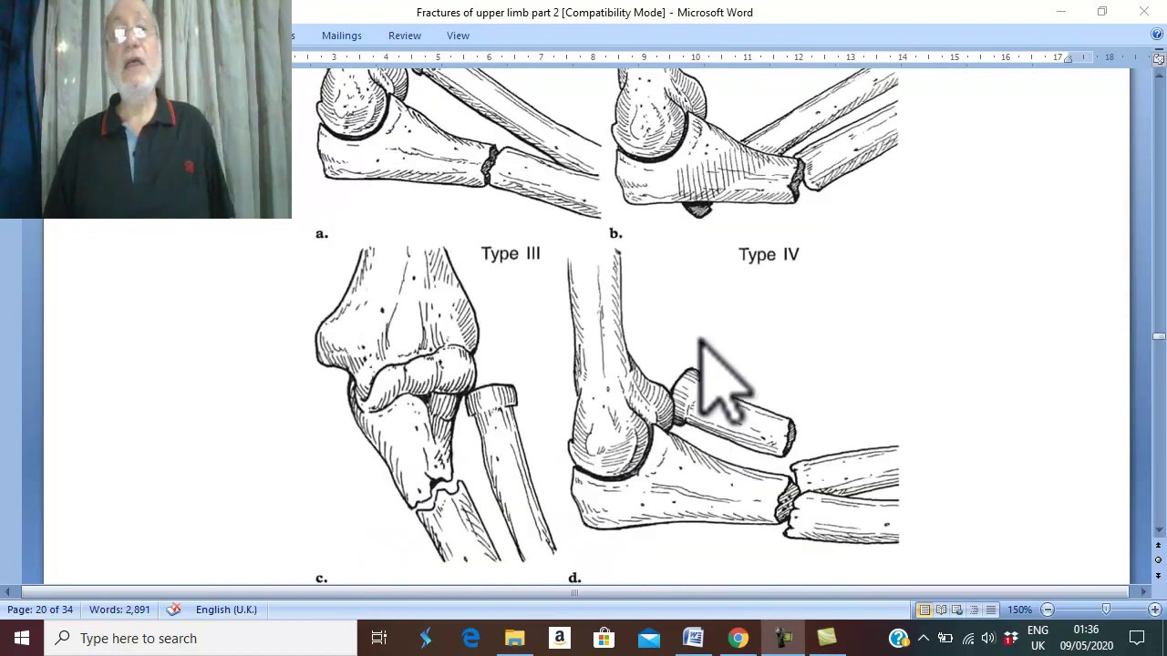 Orthopedic in Arabic  21 ( Monteggia & Galezzi Fractures Dislocations ), by Wahdan