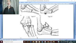 Orthopedic in Arabic  21 ( Monteggia & Galezzi Fractures Dislocations ), by Wahdan