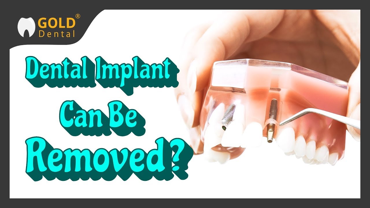 Can Dental Implants Be Removed? YouTube