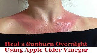 Heal a Sunburn Overnight Using Apple Cider Vinegar